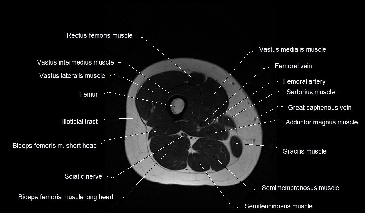 MRI thigh cross sectional anatomy image 38.webp